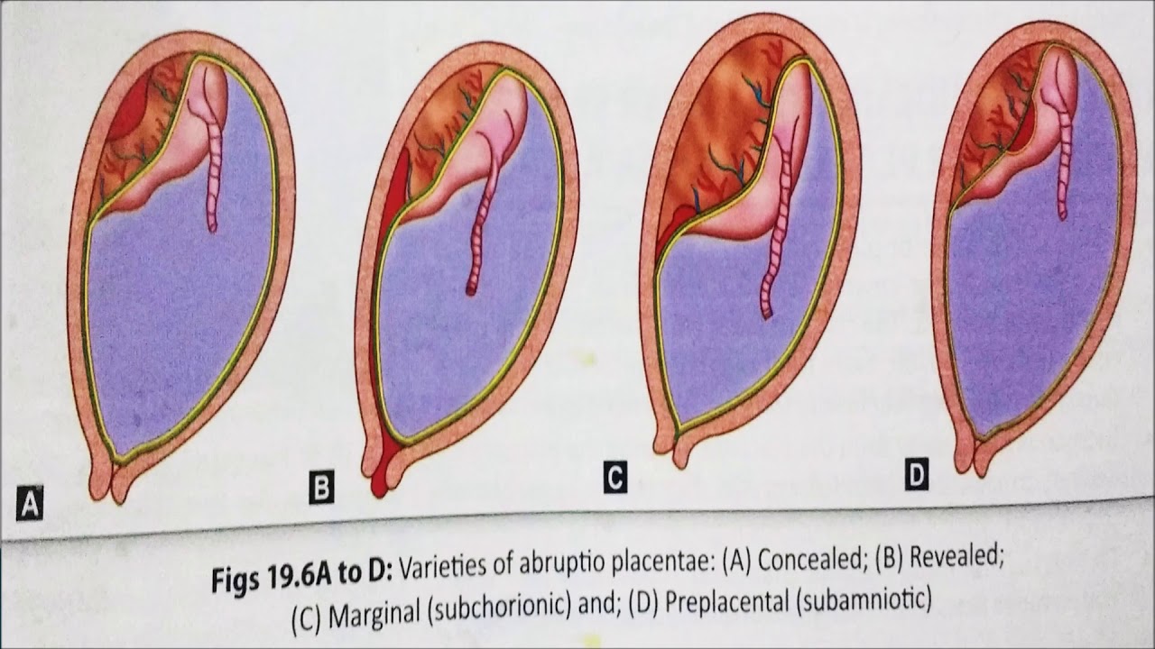 Antepartum Haemorrhage (APH), Cause And Management - Vaidyaनमः